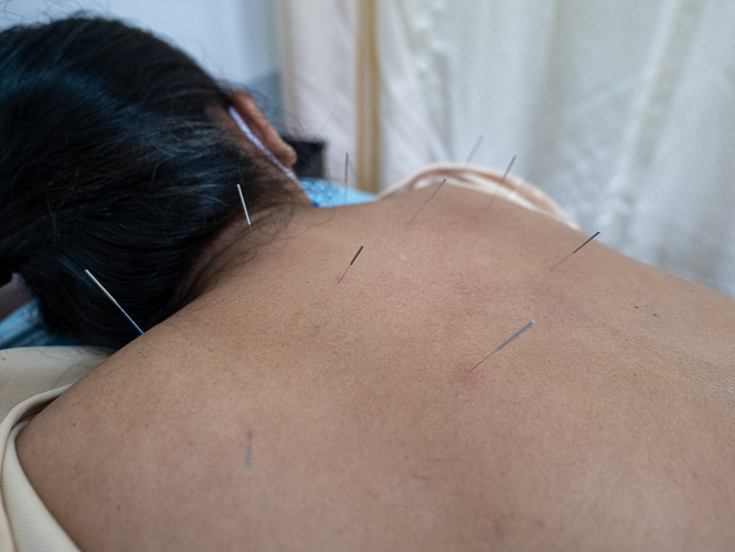 Acupuncture, a practice rooted in traditional Chinese medicine (TCM), entails the insertion of thin needles into specific points on the body to promote the flow of energy, known as 'Qi.'【Photo by Jeaneal Dando】