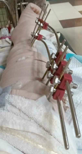 These metal rods and screws held Dionesio Austero’s broken right leg in place. Now he’s donating them to Tzu Chi Foundation so it could be of use to someone in a similar situation. / Photo courtesy of Rosevic Austero
