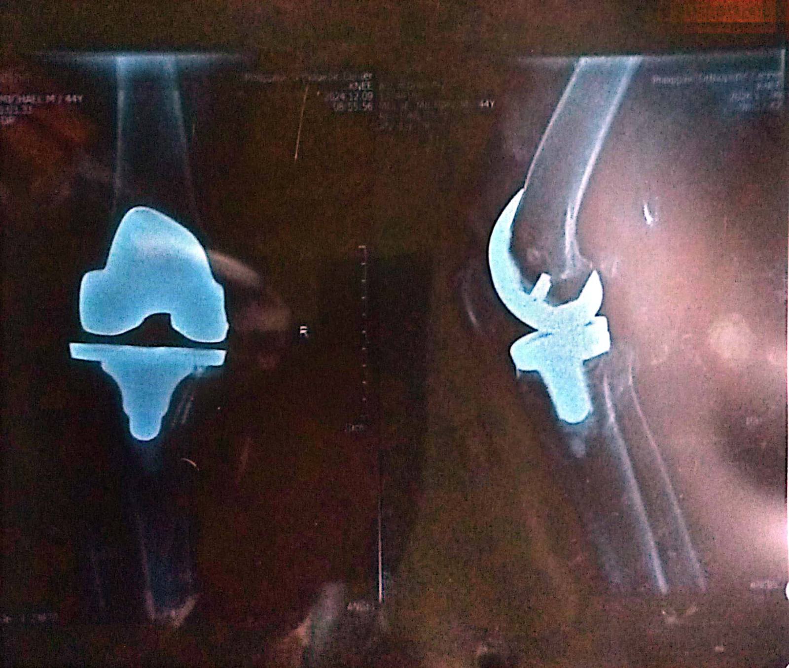 An x-ray of Michael Molve’s right knee shows the metal implant that Tzu Chi helped him secure.