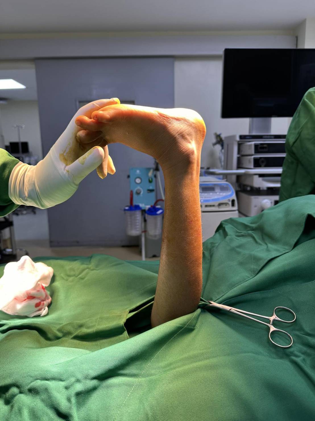 The procedure used the Z-plasty technique, which involves making precise incisions in the tendon to lengthen it and improve foot mobility.