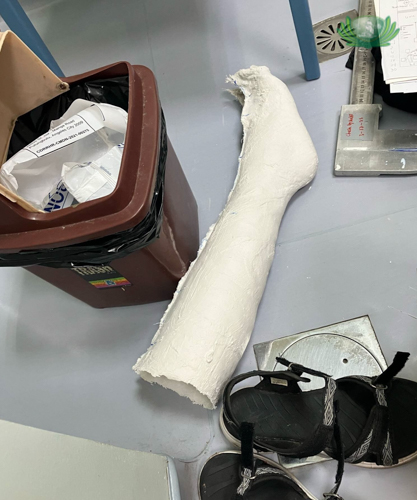 An AFO (Ankle Foot Orthosis) casting was made for Rica Serrano’s leg.