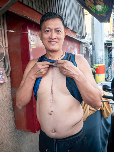 The scar that runs down Dennis Cariaga’s chest is from his open-heart surgery in May 2024. The scar on his lower left side is from a kidney stone operation in 2018. 