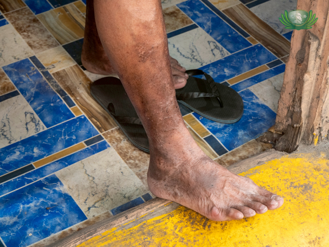 The dark stains on Dennis Cariaga’s legs are a reminder of the poor circulation he experienced from his heart condition.