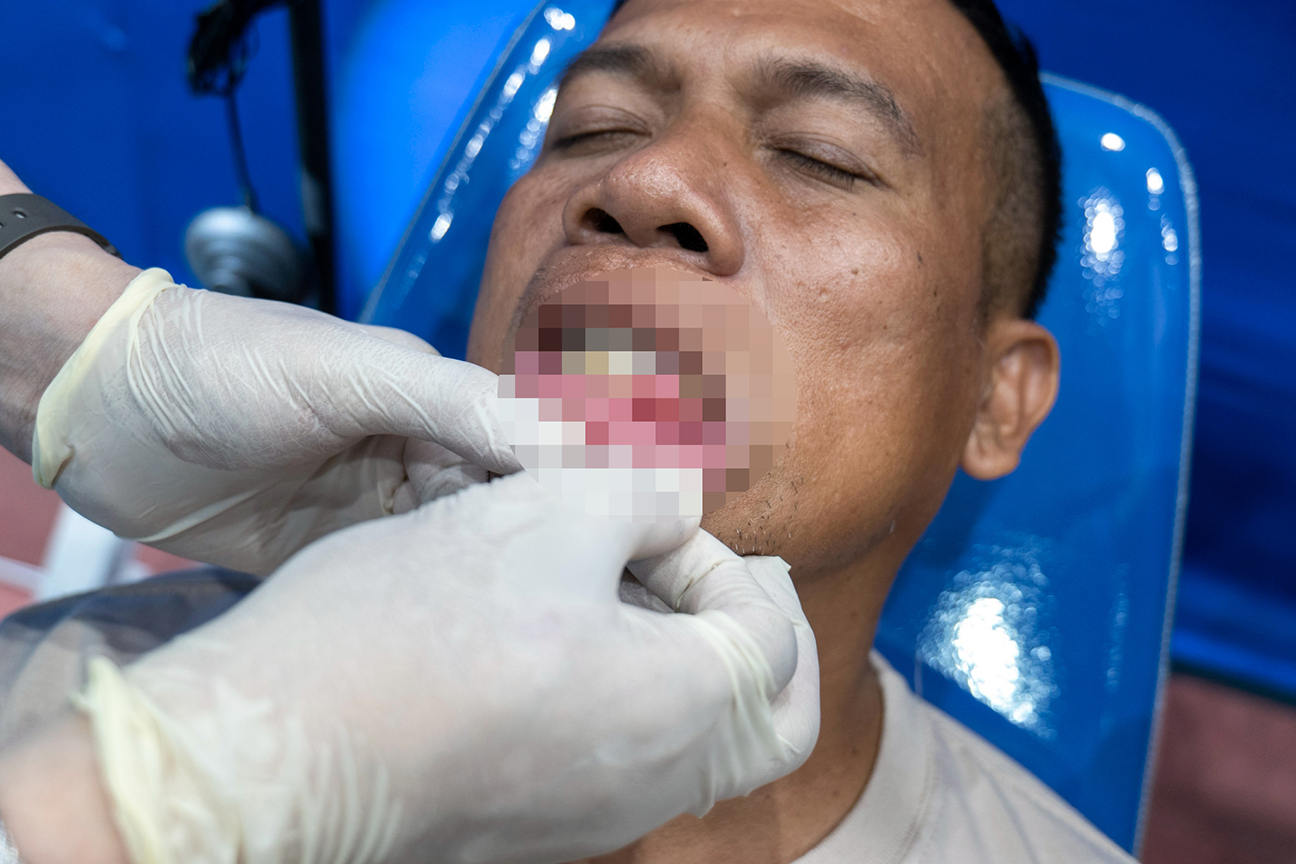 Besides extractions, volunteer dentists also performed minor surgeries like the removal of a periapical cyst, a common growth that develops from a bacterial infection.