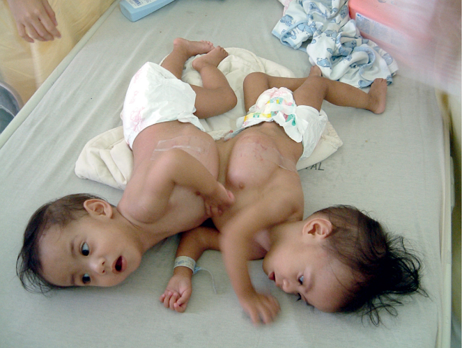 Conjoined twins Lea and Rachel Awel were born joined in the abdomen and share a liver. 