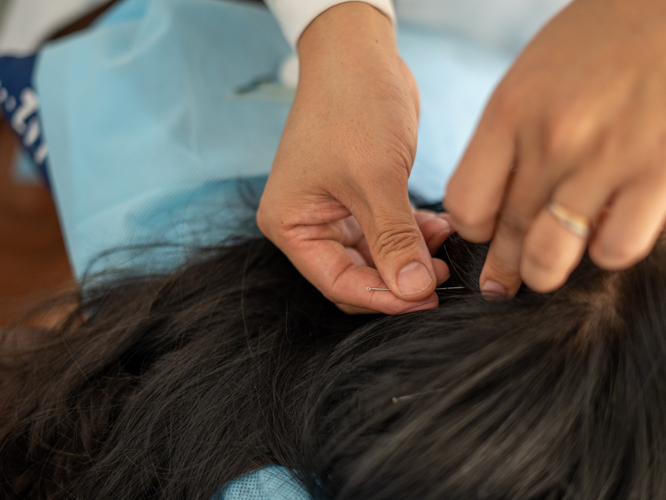 Inserting fine needles on parts of the body, including the top of a patient’s head, is believed to relieve pain and restore the flow of energy. 【Photo by Jeaneal Dando】