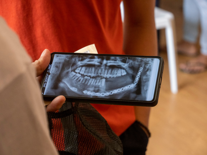 An x-ray shows the titanium plates that act as a cast to Cristopher Masbad’s jaw bone./ Photo courtesy of Cristopher Masbad【Photo by Matt Serrano】